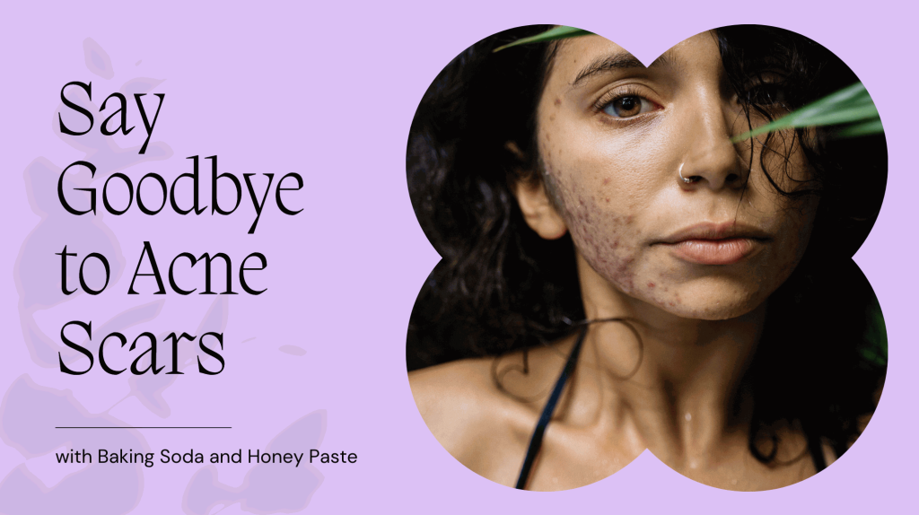 Say Goodbye to Acne Scars with Baking Soda and Honey Paste